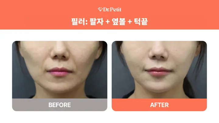 Filler for nasolabial folds, side cheeks and chin at Doctorpetit Clinic Hongdae. Doctorpetit Clinic Hongdae — Filler for nasolabial folds, side cheeks and chin. Before on the left and after on the right; follow-up interval not supplied.