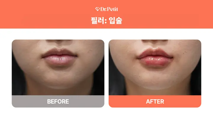 Lip filler: upper and lower lip shape at Doctorpetit Clinic Hongdae. Doctorpetit Clinic Hongdae — Lip filler: upper and lower lip shape. Before on the left and after on the right; follow-up interval not supplied.
