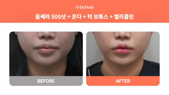 Ulthera, ONDA, jaw Botox and Bellacollin at Doctorpetit Clinic Hongdae. Doctorpetit Clinic Hongdae — Ulthera, ONDA, jaw Botox and Bellacollin. Before on the left and after on the right; follow-up interval not supplied.