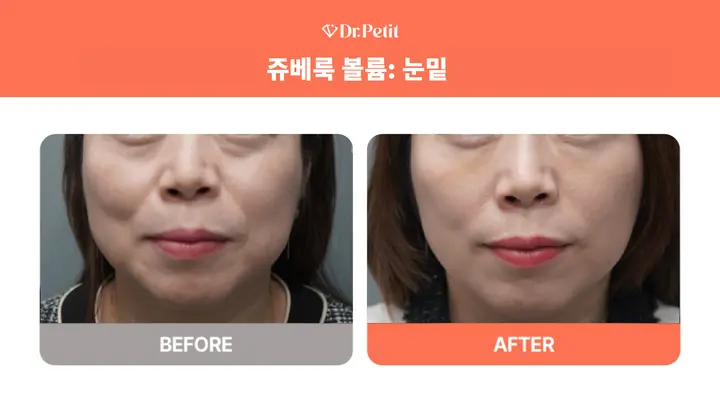 Juvelook Volume: under-eye comparison at Doctorpetit Clinic Hongdae. Doctorpetit Clinic Hongdae — Juvelook Volume: under-eye comparison. Before on the left and after on the right; follow-up interval not supplied.