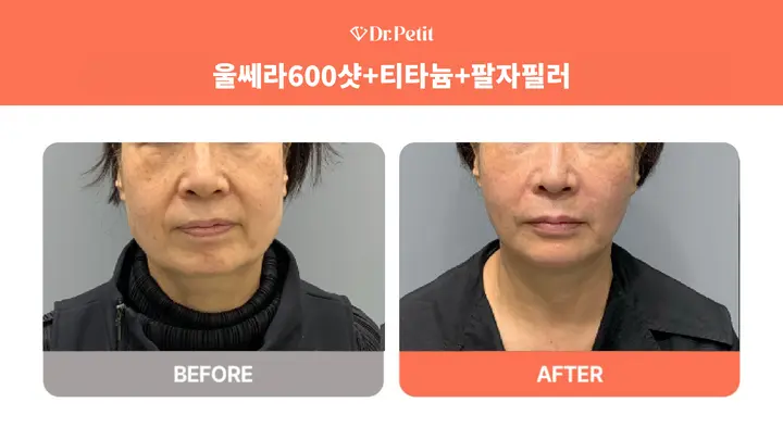 Ulthera, Titanium and nasolabial-fold filler at Doctorpetit Clinic Hongdae. Doctorpetit Clinic Hongdae — Ulthera, Titanium and nasolabial-fold filler. Before on the left and after on the right; follow-up interval not supplied.