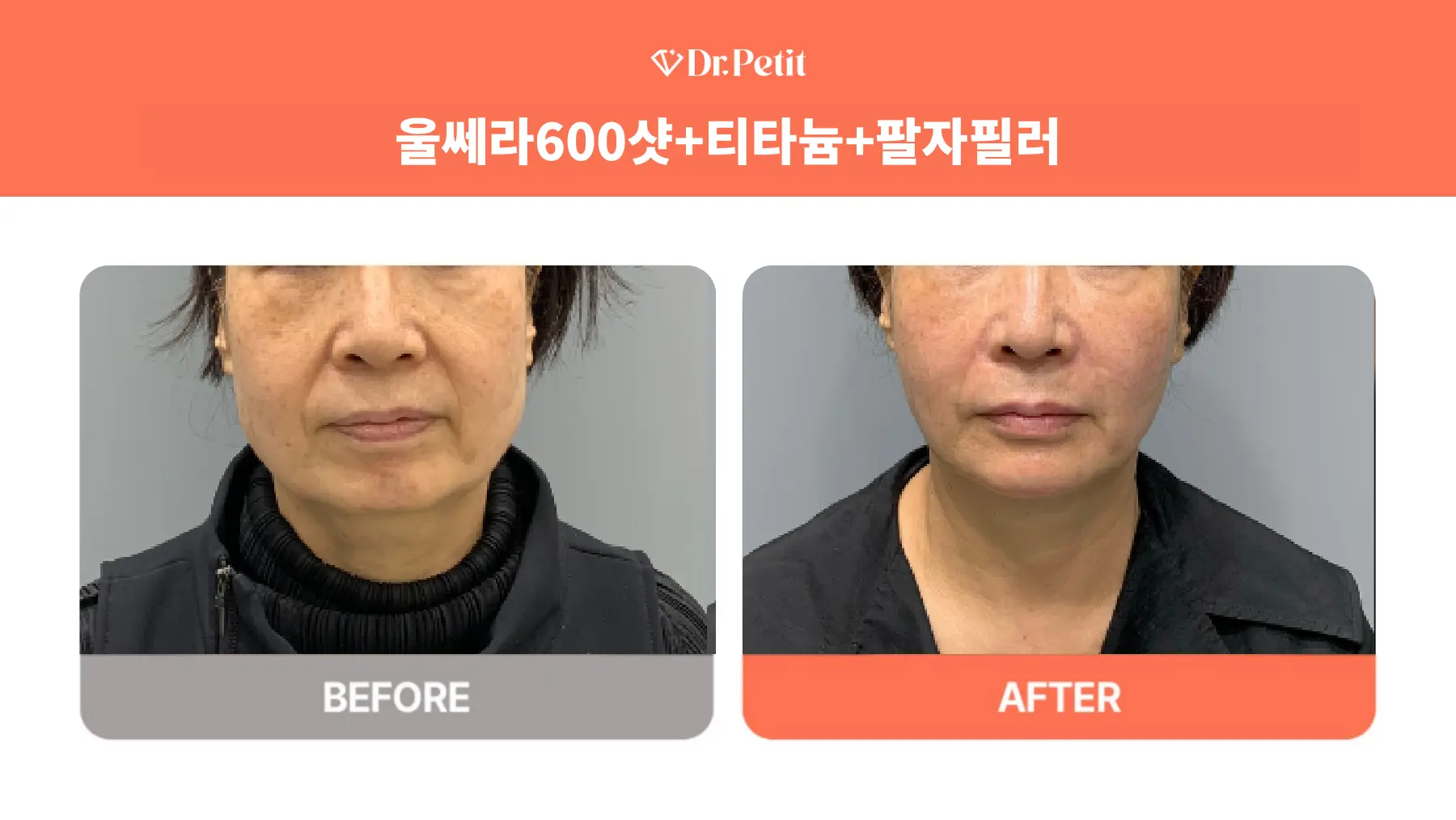 Ulthera, Titanium and nasolabial-fold filler at Doctorpetit Clinic Hongdae. Doctorpetit Clinic Hongdae — Ulthera, Titanium and nasolabial-fold filler. Before on the left and after on the right; follow-up interval not supplied.