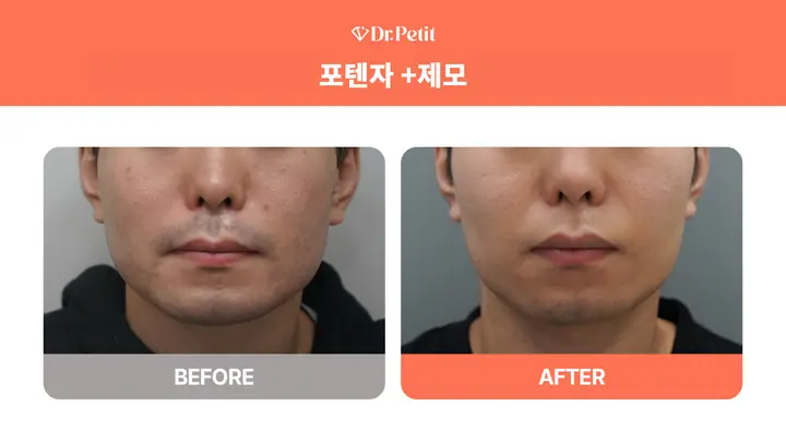 Potenza and facial hair removal at Doctorpetit Clinic Hongdae. Doctorpetit Clinic Hongdae — Potenza and facial hair removal. Before on the left and after on the right; follow-up interval not supplied.