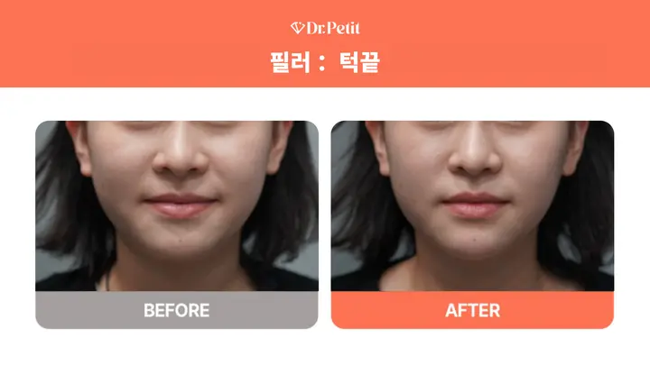 Chin filler: front facial comparison at Doctorpetit Clinic Hongdae. Doctorpetit Clinic Hongdae — Chin filler: front facial comparison. Before on the left and after on the right; follow-up interval not supplied.