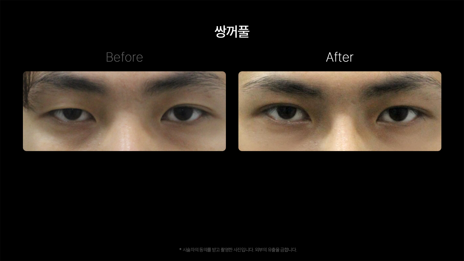 Double-eyelid surgery — front view at Dojagi Clinic. Dojagi Clinic, Seoul: double-eyelid surgery — front view, with before on the left and after on the right as labelled in the supplied image. Follow-up interval not supplied.