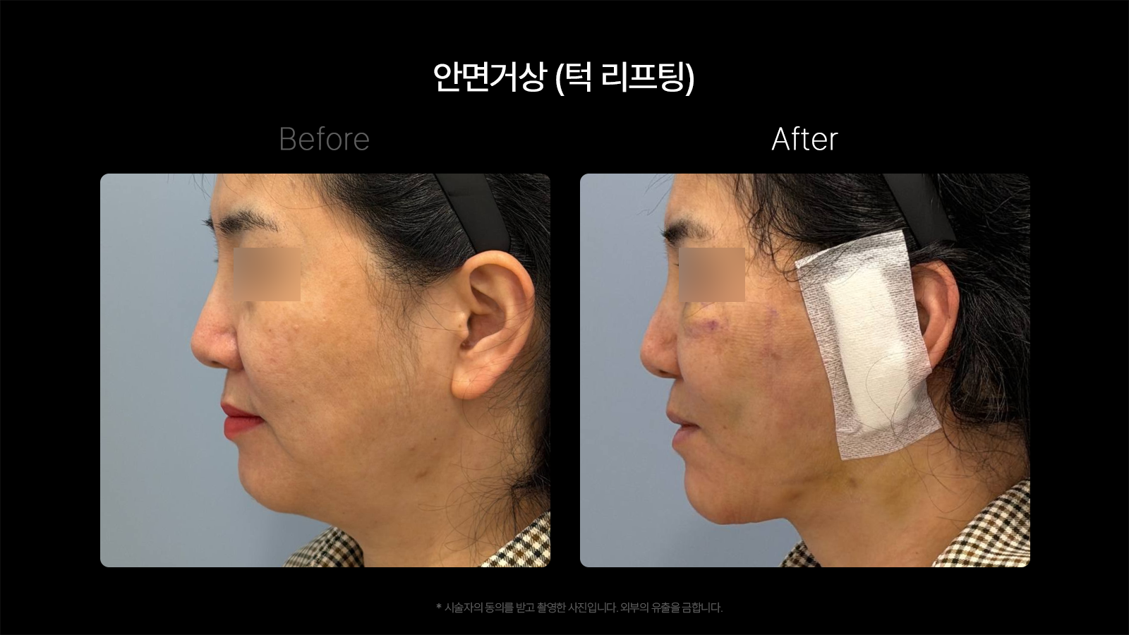 Facelift — side-view comparison at Dojagi Clinic. Dojagi Clinic, Seoul: facelift — side-view comparison, with before on the left and after on the right as labelled in the supplied image. Follow-up interval not supplied.