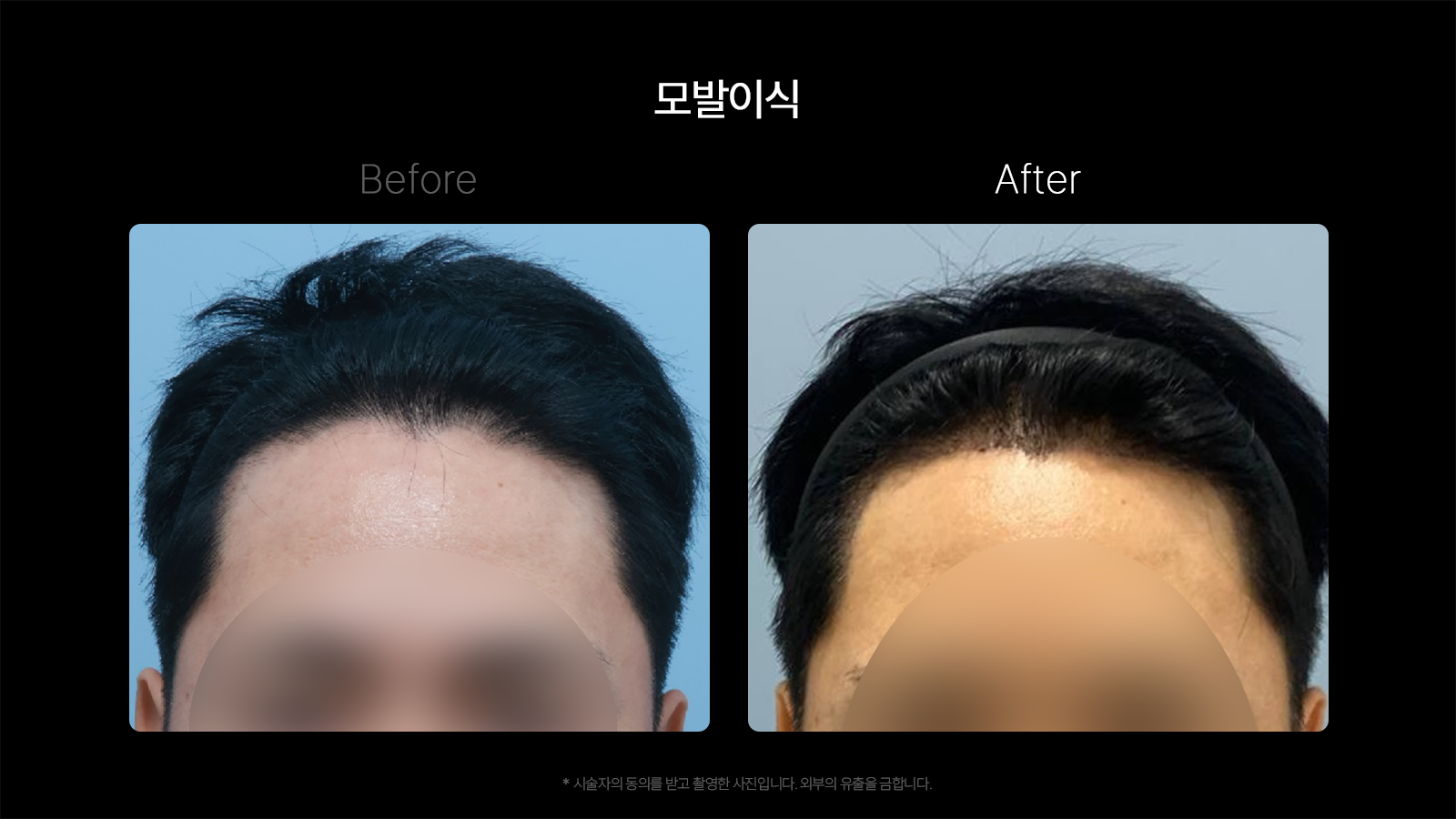 Hair transplantation — frontal hairline at Dojagi Clinic. Dojagi Clinic, Seoul: hair transplantation — frontal hairline, with before on the left and after on the right as labelled in the supplied image. Follow-up interval not supplied.