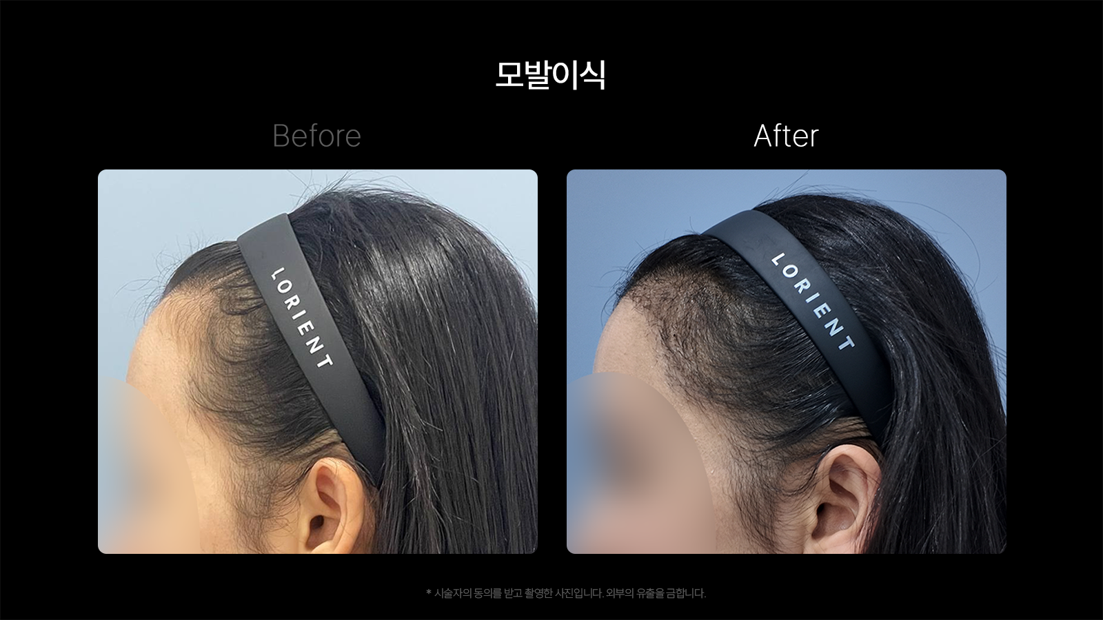 Hair transplantation — side hairline at Dojagi Clinic. Dojagi Clinic, Seoul: hair transplantation — side hairline, with before on the left and after on the right as labelled in the supplied image. Follow-up interval not supplied.
