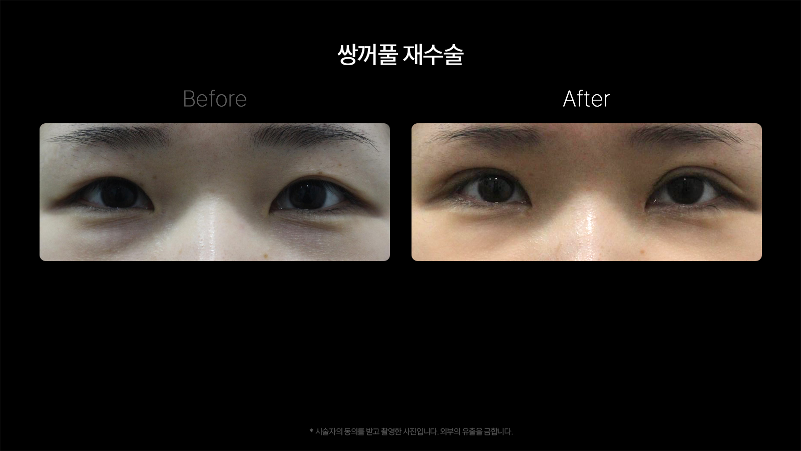 Revision double-eyelid surgery — comparison 01 at Dojagi Clinic. Dojagi Clinic, Seoul: revision double-eyelid surgery — comparison 01, with before on the left and after on the right as labelled in the supplied image. Follow-up interval not supplied.