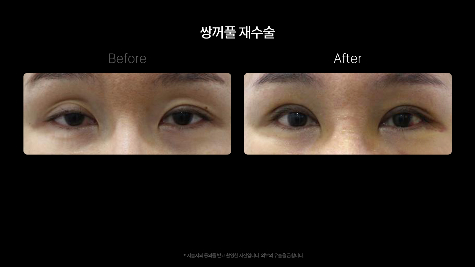 Revision double-eyelid surgery — comparison 02 at Dojagi Clinic. Dojagi Clinic, Seoul: revision double-eyelid surgery — comparison 02, with before on the left and after on the right as labelled in the supplied image. Follow-up interval not supplied.