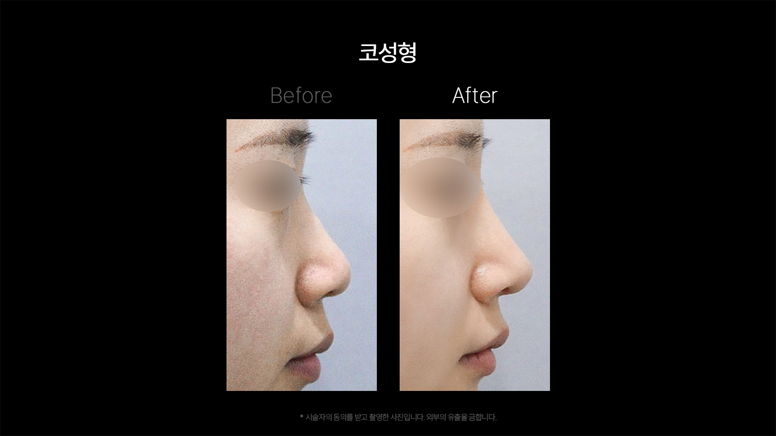 Rhinoplasty — profile comparison 01 at Dojagi Clinic. Dojagi Clinic, Seoul: rhinoplasty — profile comparison 01, with before on the left and after on the right as labelled in the supplied image. Follow-up interval not supplied.