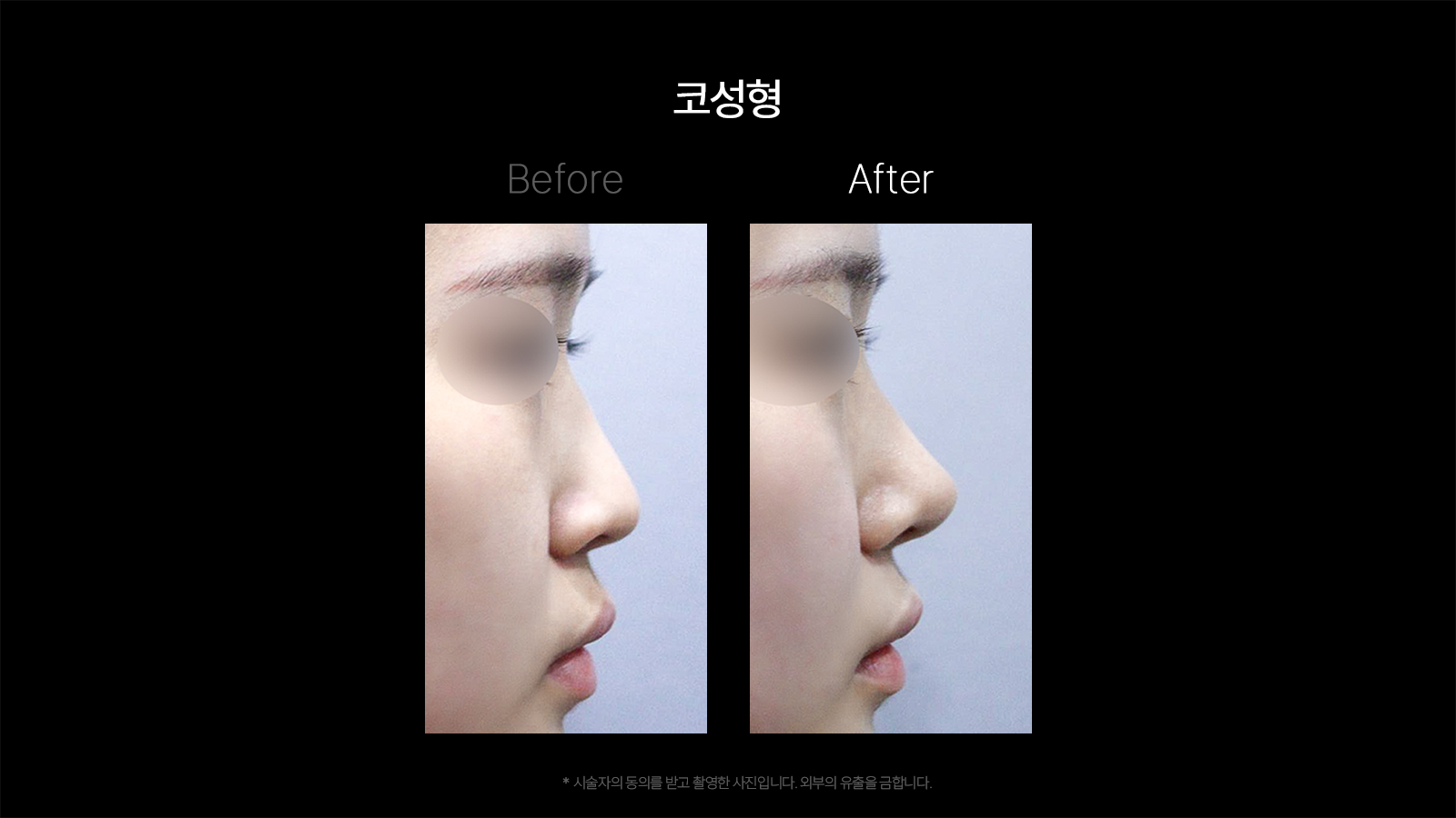 Rhinoplasty — profile comparison 02 at Dojagi Clinic. Dojagi Clinic, Seoul: rhinoplasty — profile comparison 02, with before on the left and after on the right as labelled in the supplied image. Follow-up interval not supplied.