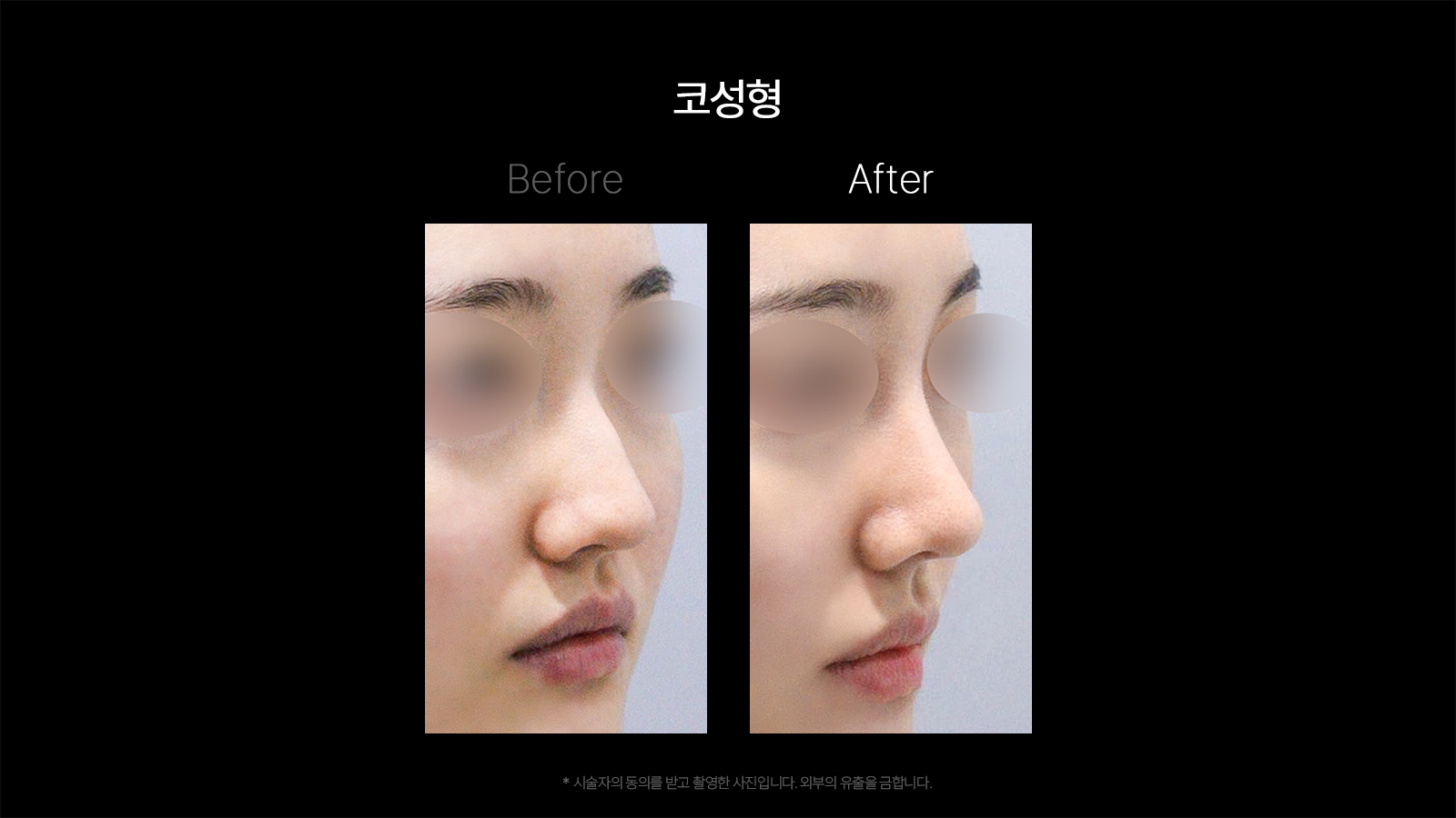 Rhinoplasty — angled comparison at Dojagi Clinic. Dojagi Clinic, Seoul: rhinoplasty — angled comparison, with before on the left and after on the right as labelled in the supplied image. Follow-up interval not supplied.