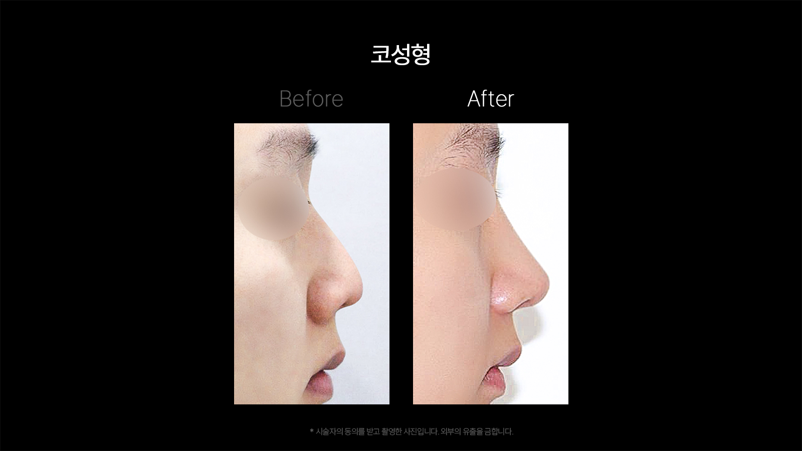 Rhinoplasty — profile comparison 04 at Dojagi Clinic. Dojagi Clinic, Seoul: rhinoplasty — profile comparison 04, with before on the left and after on the right as labelled in the supplied image. Follow-up interval not supplied.