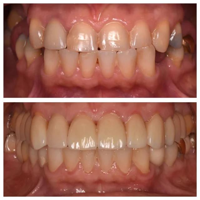 Front teeth: a closer look at the central gap at Dongdaemun Dental Clinic. Dongdaemun Dental Clinic — Stacked front-tooth views showing a central gap in the upper panel and a closed-looking contact in the lower panel.