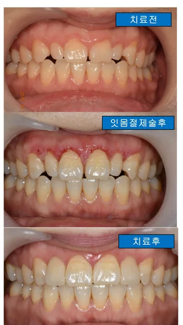 Gum contouring and crowns: three treatment stages at Dongdaemun Dental Clinic. Dongdaemun Dental Clinic — Upper front teeth before treatment, after gingivectomy and after treatment, arranged from top to bottom.