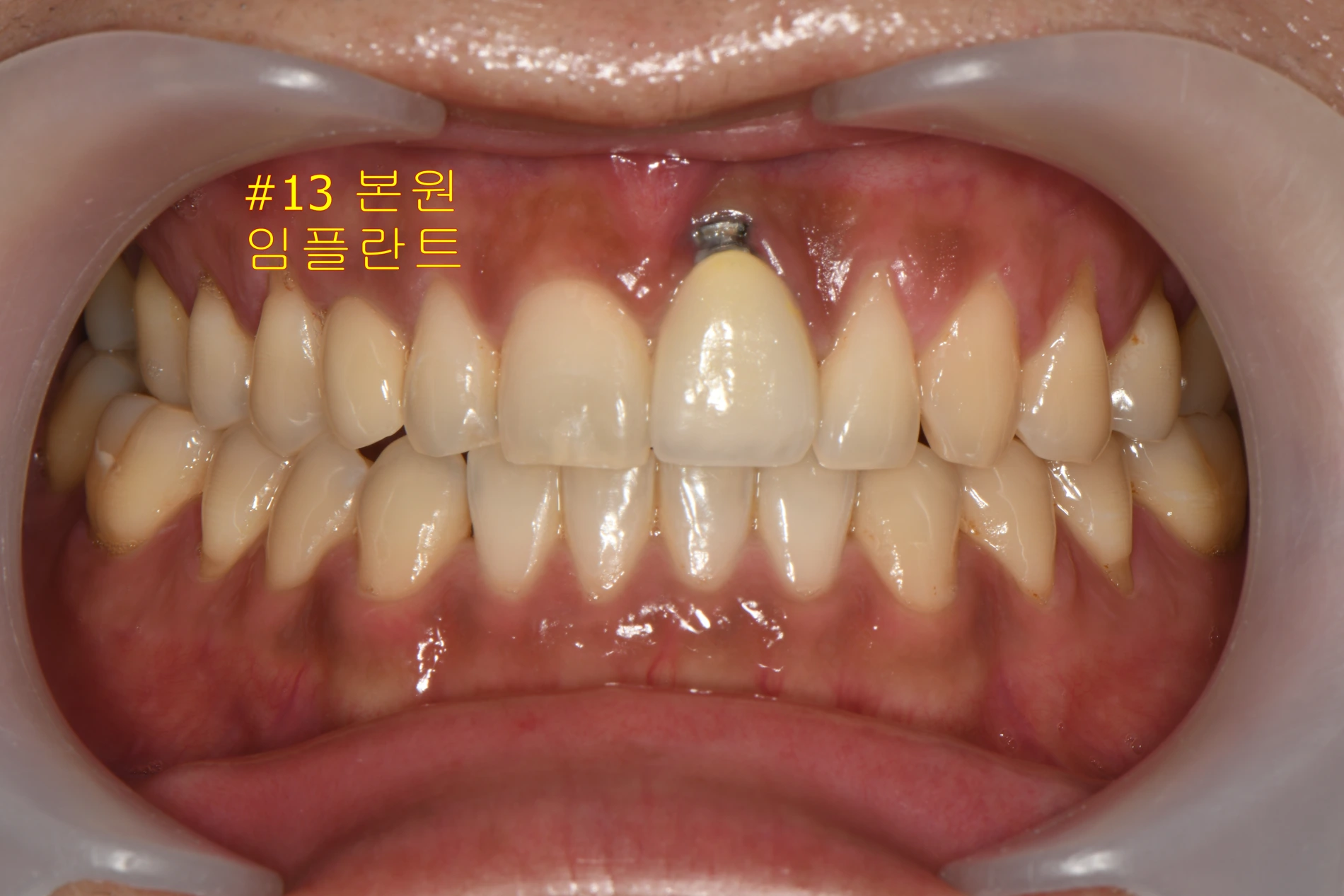 Dongdaemun Dental Clinic — Single photograph comparing two implant tooth sites; the annotation identifies the implant at tooth 13 as placed at this clinic.