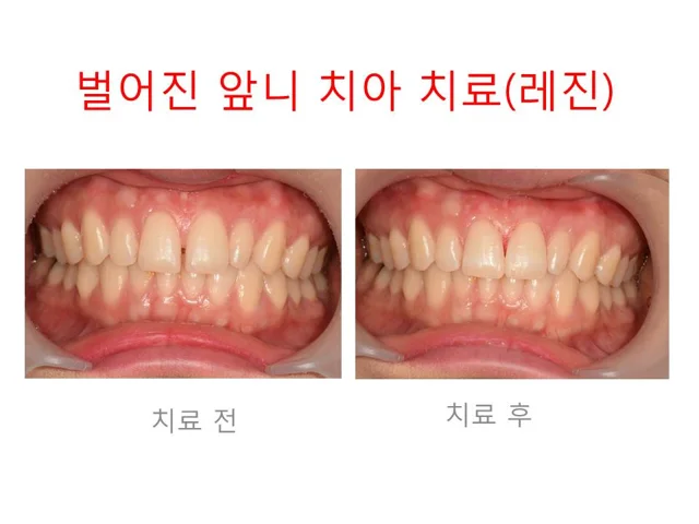 Resin bonding for a gap between the front teeth at Dongdaemun Dental Clinic. Dongdaemun Dental Clinic — Resin bonding for an upper front-tooth gap, before on the left and after on the right.