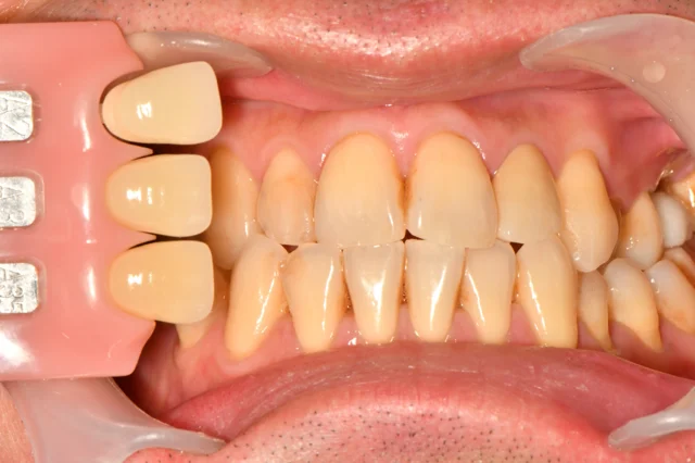 Whitening: tooth colour in close-up at Dongdaemun Dental Clinic. Dongdaemun Dental Clinic — Before whitening: close-up of the front teeth with a shade tab below the upper teeth.