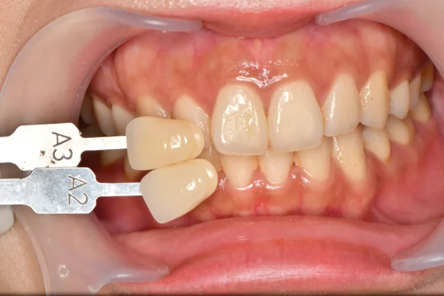 Whitening: a front-facing tooth-colour comparison at Dongdaemun Dental Clinic. Dongdaemun Dental Clinic — Before whitening: front-facing view of upper and lower teeth with shade references.