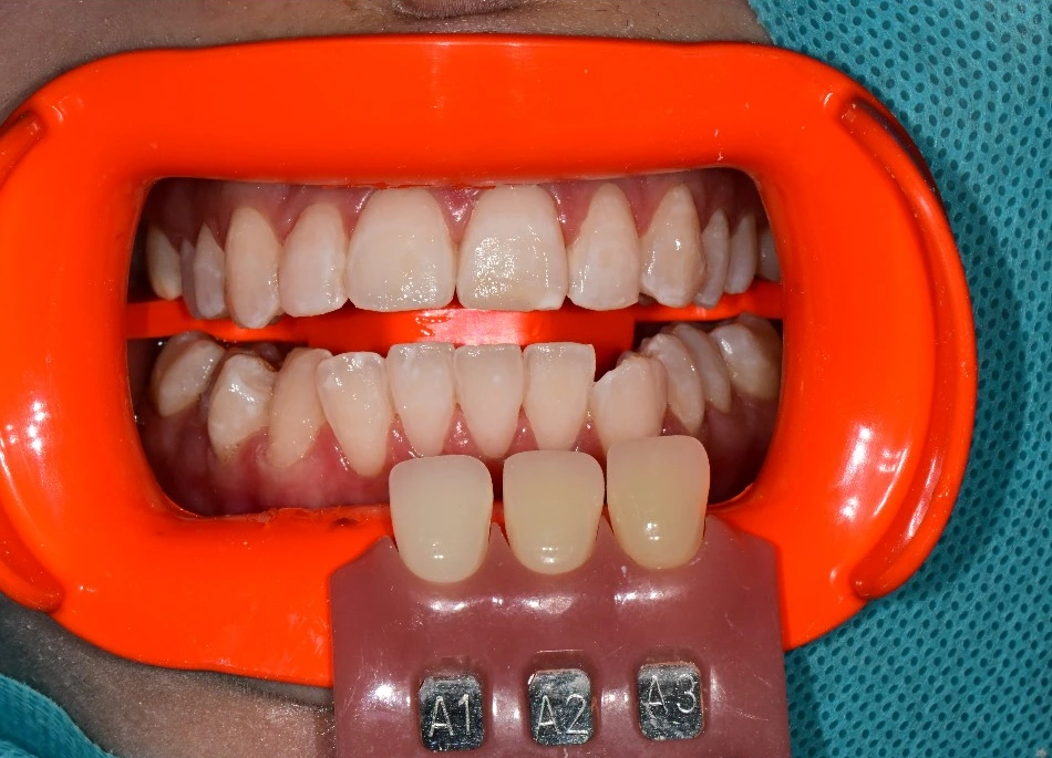 Whitening: upper and lower teeth beside shade tabs at Dongdaemun Dental Clinic. Dongdaemun Dental Clinic — After whitening: upper and lower teeth with an orange retractor and A1, A2 and A3 shade tabs.