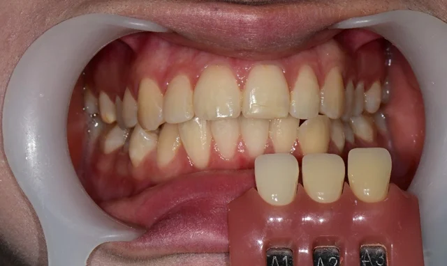 Whitening: upper and lower teeth beside shade tabs at Dongdaemun Dental Clinic. Dongdaemun Dental Clinic — Before whitening: upper and lower teeth with A1, A2 and A3 shade tabs.
