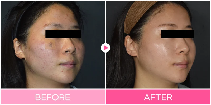 3D facial contouring: cheek and jaw profile at EG DONG AN Clinic. EG DONG AN Clinic, Seoul — 3d facial contouring: cheek and jaw profile. Before on the left; after on the right.