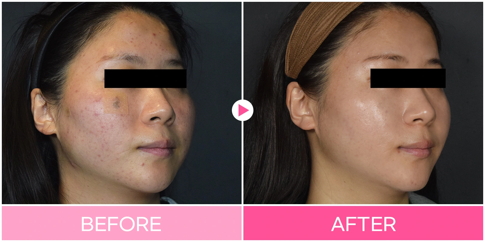 3D facial contouring: cheek and jaw profile at EG DONG AN Clinic. EG DONG AN Clinic, Seoul — 3d facial contouring: cheek and jaw profile. Before on the left; after on the right.