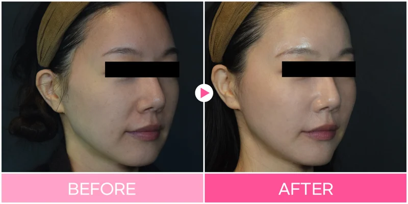 3D facial contouring: midface comparison at EG DONG AN Clinic. EG DONG AN Clinic, Seoul — 3d facial contouring: midface comparison. Before on the left; after on the right.