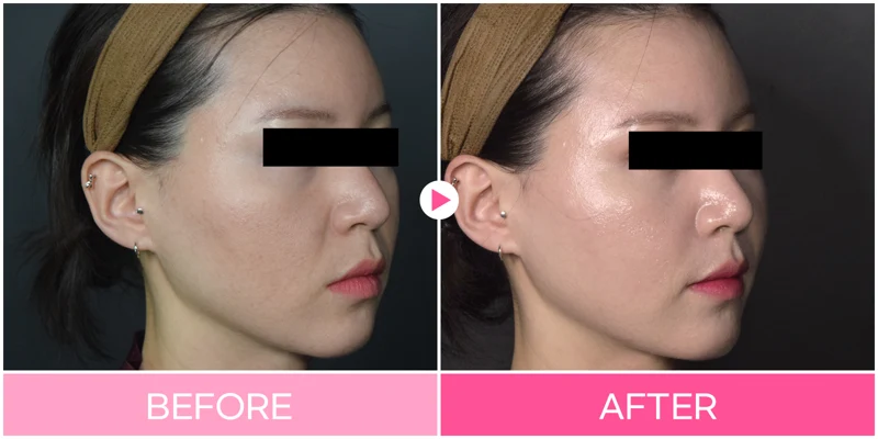 3D facial contouring: oblique facial outline at EG DONG AN Clinic. EG DONG AN Clinic, Seoul — 3d facial contouring: oblique facial outline. Before on the left; after on the right.