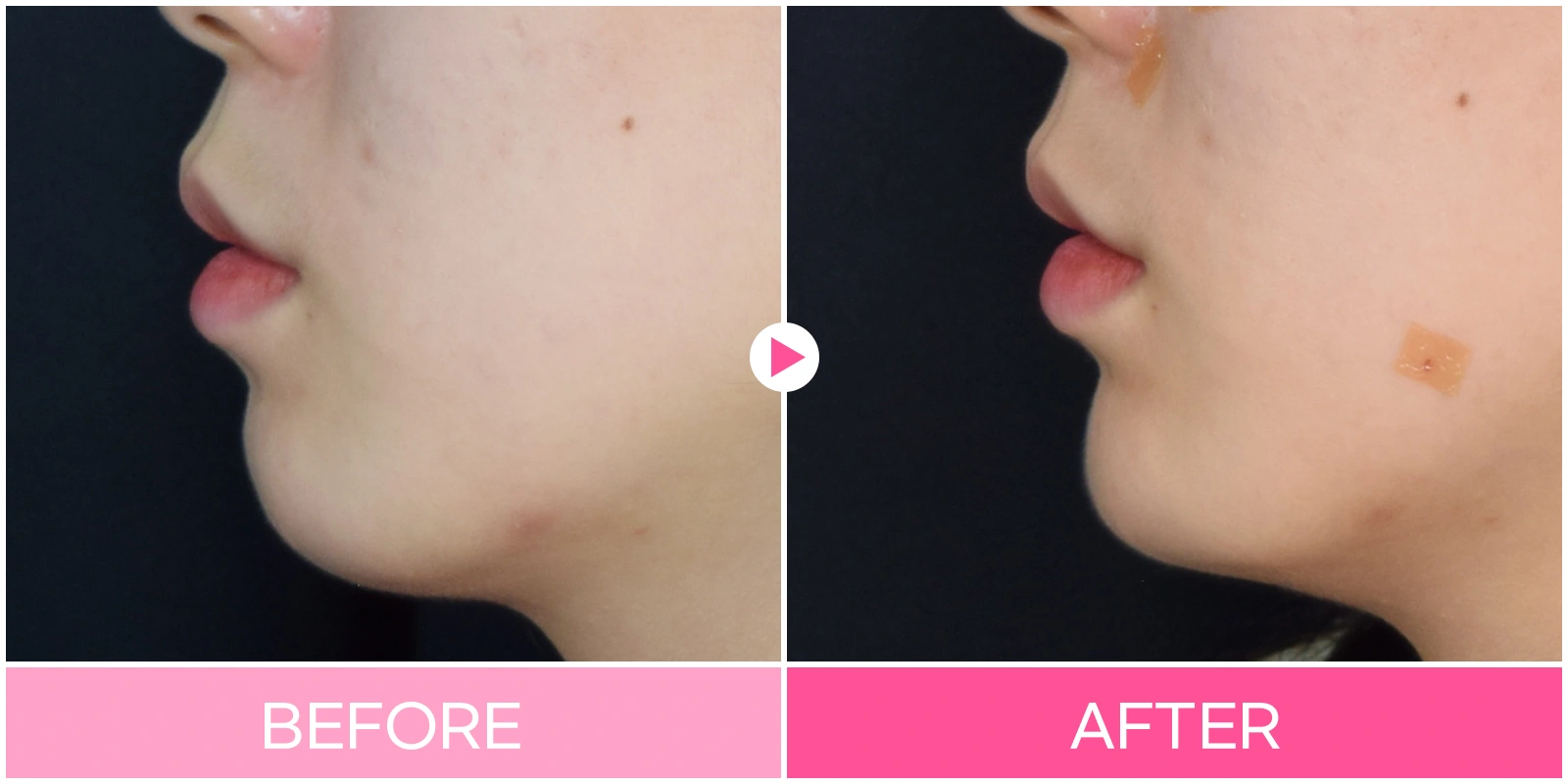 Chin contouring: lower-lip-to-chin profile at EG DONG AN Clinic. EG DONG AN Clinic, Seoul — chin contouring: lower-lip-to-chin profile. Before on the left; after on the right.