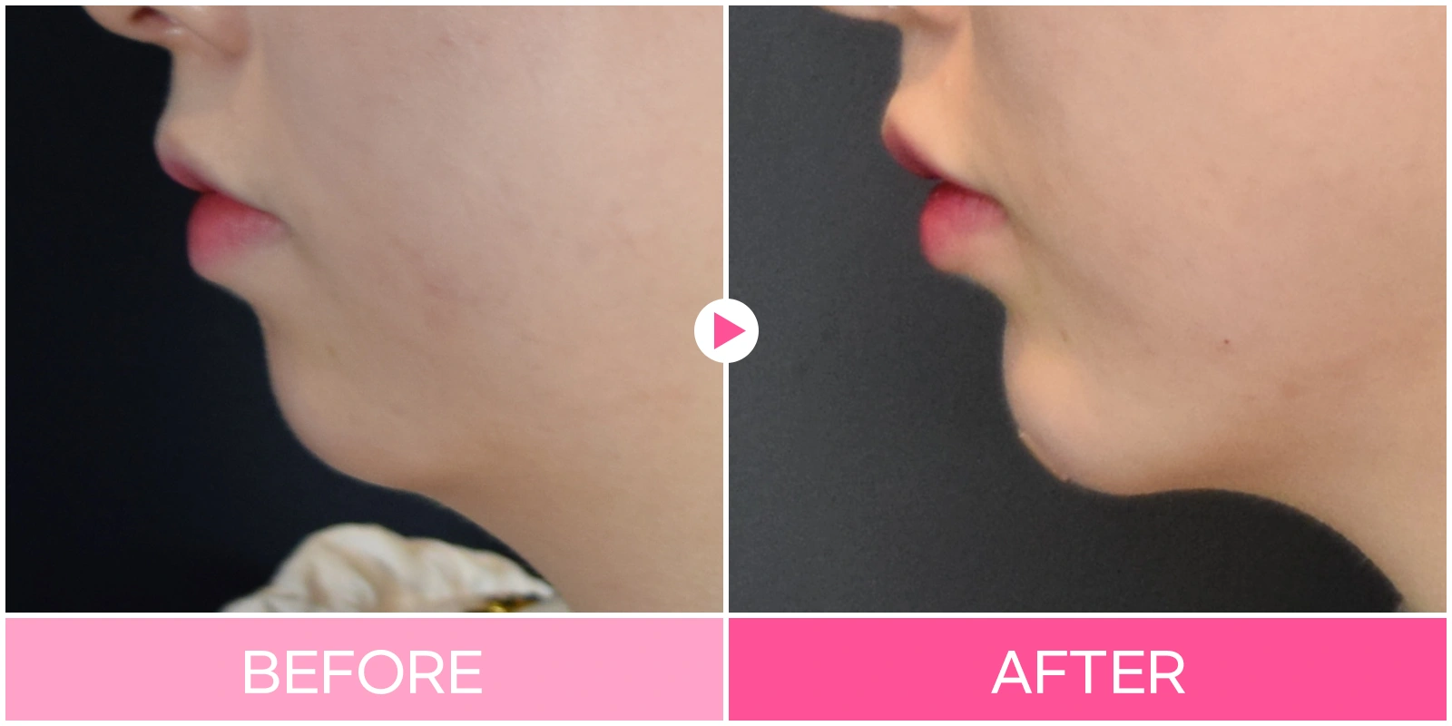 Chin contouring: side-view projection at EG DONG AN Clinic. EG DONG AN Clinic, Seoul — chin contouring: side-view projection. Before on the left; after on the right.