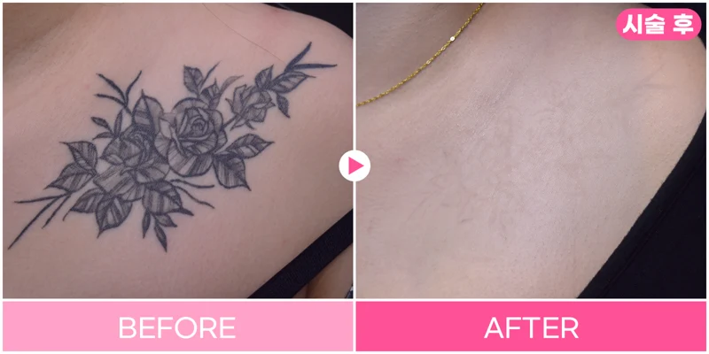 Tattoo removal: floral chest design at EG DONG AN Clinic. EG DONG AN Clinic, Seoul — tattoo removal: floral chest design. Before on the left; after on the right.