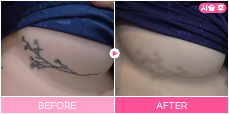 Tattoo removal: smaller floral design at EG DONG AN Clinic. EG DONG AN Clinic, Seoul — tattoo removal: smaller floral design. Before on the left; after on the right.