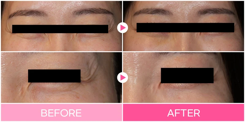 Collaren eye-area treatment: two close-up views at EG DONG AN Clinic. EG DONG AN Clinic, Seoul — collaren eye-area treatment: two close-up views. Before on the left; after on the right.