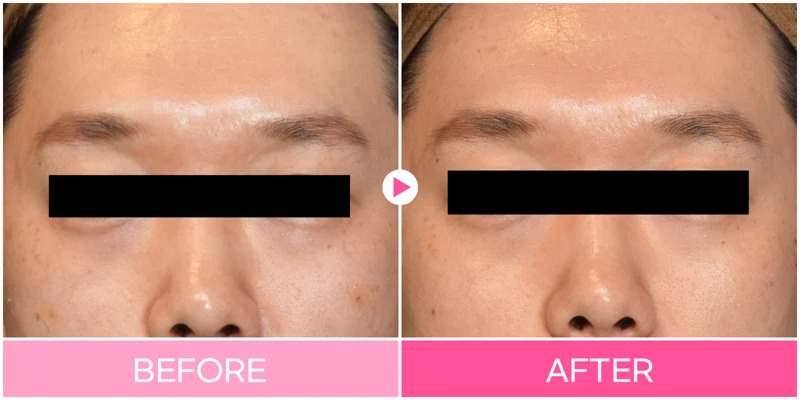 Under-eye filler: frontal tear-trough comparison at EG DONG AN Clinic. EG DONG AN Clinic, Seoul — under-eye filler: frontal tear-trough comparison. Before on the left; after on the right.