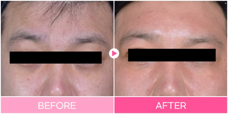 Under-eye filler: lower-eyelid and cheek contours at EG DONG AN Clinic. EG DONG AN Clinic, Seoul — under-eye filler: lower-eyelid and cheek contours. Before on the left; after on the right.