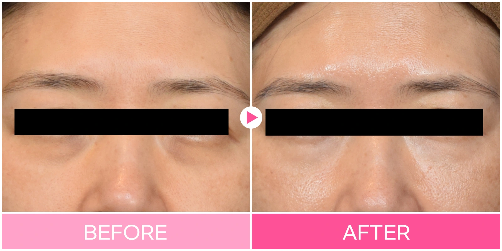 Under-eye filler: close view of both tear troughs at EG DONG AN Clinic. EG DONG AN Clinic, Seoul — under-eye filler: close view of both tear troughs. Before on the left; after on the right.