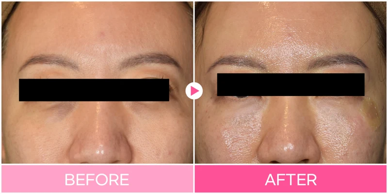 Under-eye filler: upper-cheek transition at EG DONG AN Clinic. EG DONG AN Clinic, Seoul — under-eye filler: upper-cheek transition. Before on the left; after on the right.