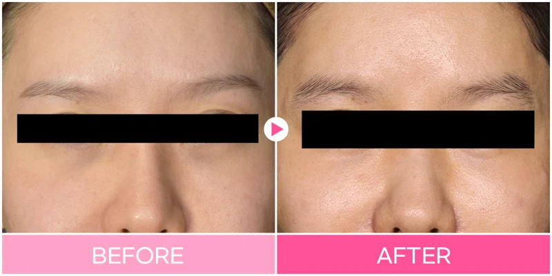 Under-eye filler: lower-eyelid shadow comparison at EG DONG AN Clinic. EG DONG AN Clinic, Seoul — under-eye filler: lower-eyelid shadow comparison. Before on the left; after on the right.