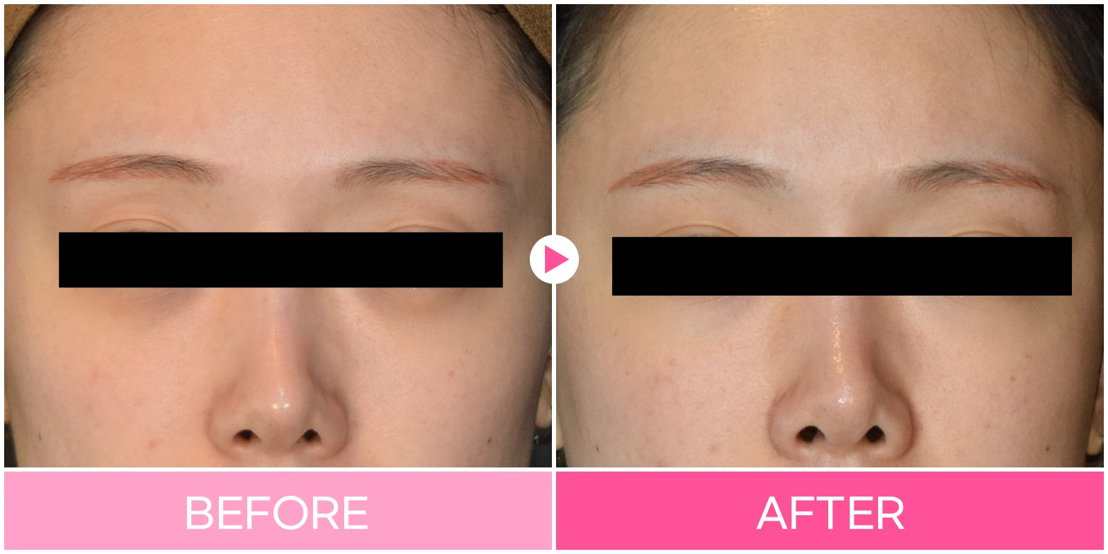 Under-eye filler: front-facing midface view at EG DONG AN Clinic. EG DONG AN Clinic, Seoul — under-eye filler: front-facing midface view. Before on the left; after on the right.