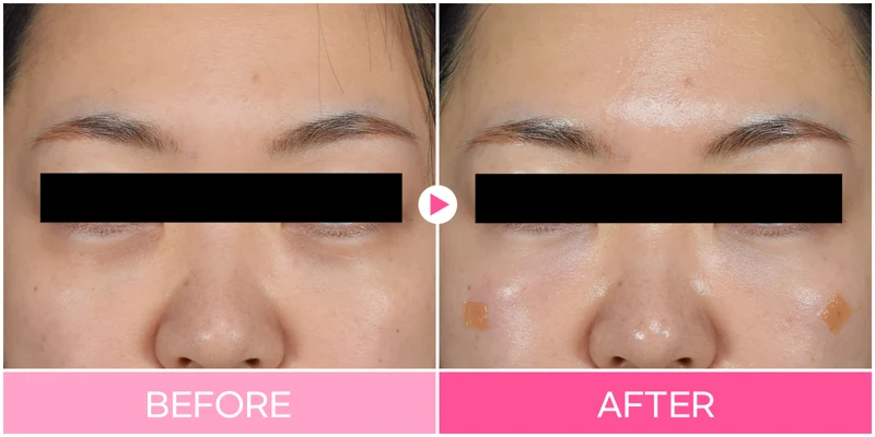 Under-eye filler: tear troughs and cheek detail at EG DONG AN Clinic. EG DONG AN Clinic, Seoul — under-eye filler: tear troughs and cheek detail. Before on the left; after on the right.