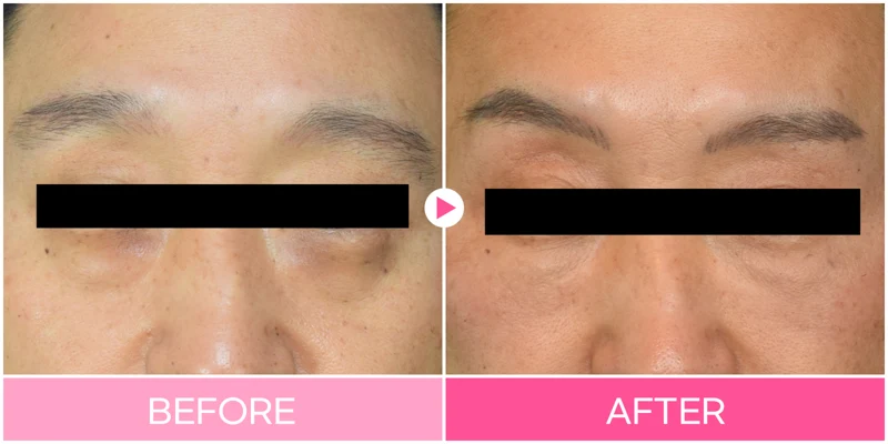 Under-eye filler: inner-corner-to-cheek view at EG DONG AN Clinic. EG DONG AN Clinic, Seoul — under-eye filler: inner-corner-to-cheek view. Before on the left; after on the right.