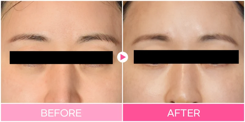 Under-eye filler: broad midface crop at EG DONG AN Clinic. EG DONG AN Clinic, Seoul — under-eye filler: broad midface crop. Before on the left; after on the right.