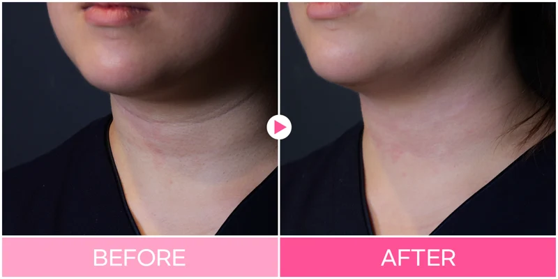 Neck-line filler: angled neck comparison at EG DONG AN Clinic. EG DONG AN Clinic, Seoul — neck-line filler: angled neck comparison. Before on the left; after on the right.