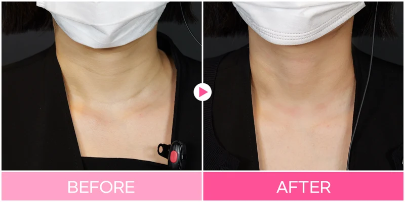 Neck-line filler: front-of-neck comparison at EG DONG AN Clinic. EG DONG AN Clinic, Seoul — neck-line filler: front-of-neck comparison. Before on the left; after on the right.