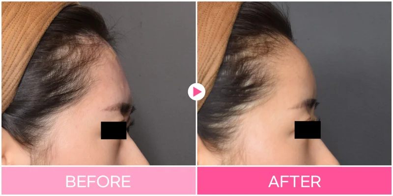Forehead filler: side-profile contour at EG DONG AN Clinic. EG DONG AN Clinic, Seoul — forehead filler: side-profile contour. Before on the left; after on the right.