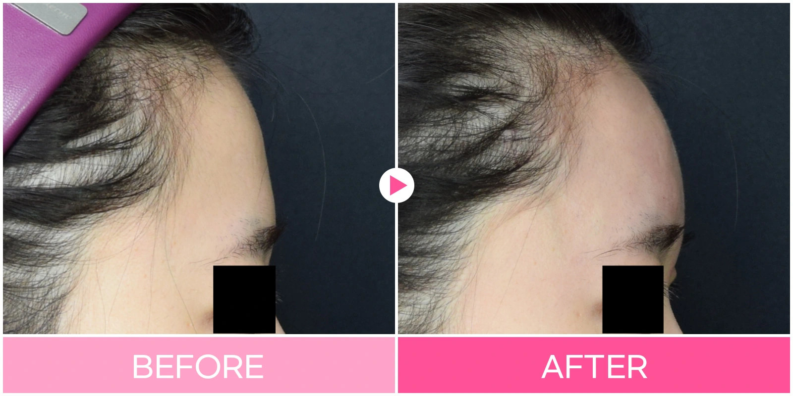 Forehead filler: upper-forehead projection at EG DONG AN Clinic. EG DONG AN Clinic, Seoul — forehead filler: upper-forehead projection. Before on the left; after on the right.
