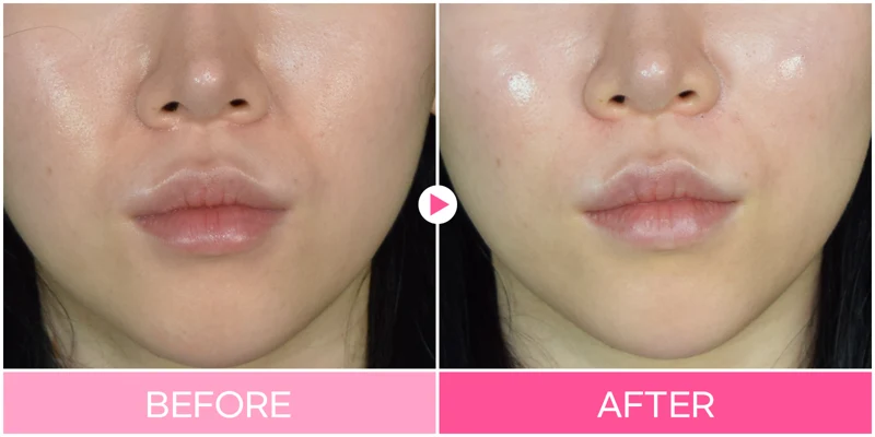Nasolabial-fold filler: upper-lip and cheek view at EG DONG AN Clinic. EG DONG AN Clinic, Seoul — nasolabial-fold filler: upper-lip and cheek view. Before on the left; after on the right.