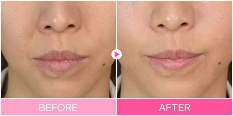 Nasolabial-fold filler: close-up around the mouth at EG DONG AN Clinic. EG DONG AN Clinic, Seoul — nasolabial-fold filler: close-up around the mouth. Before on the left; after on the right.